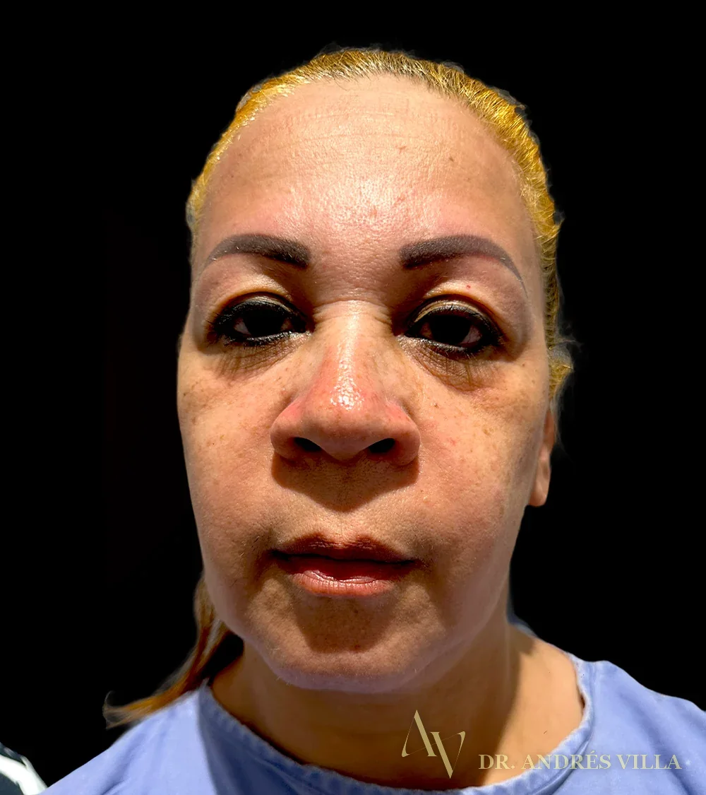 Blefaroplastia. Antes y después, de frente: deslice para comparar.