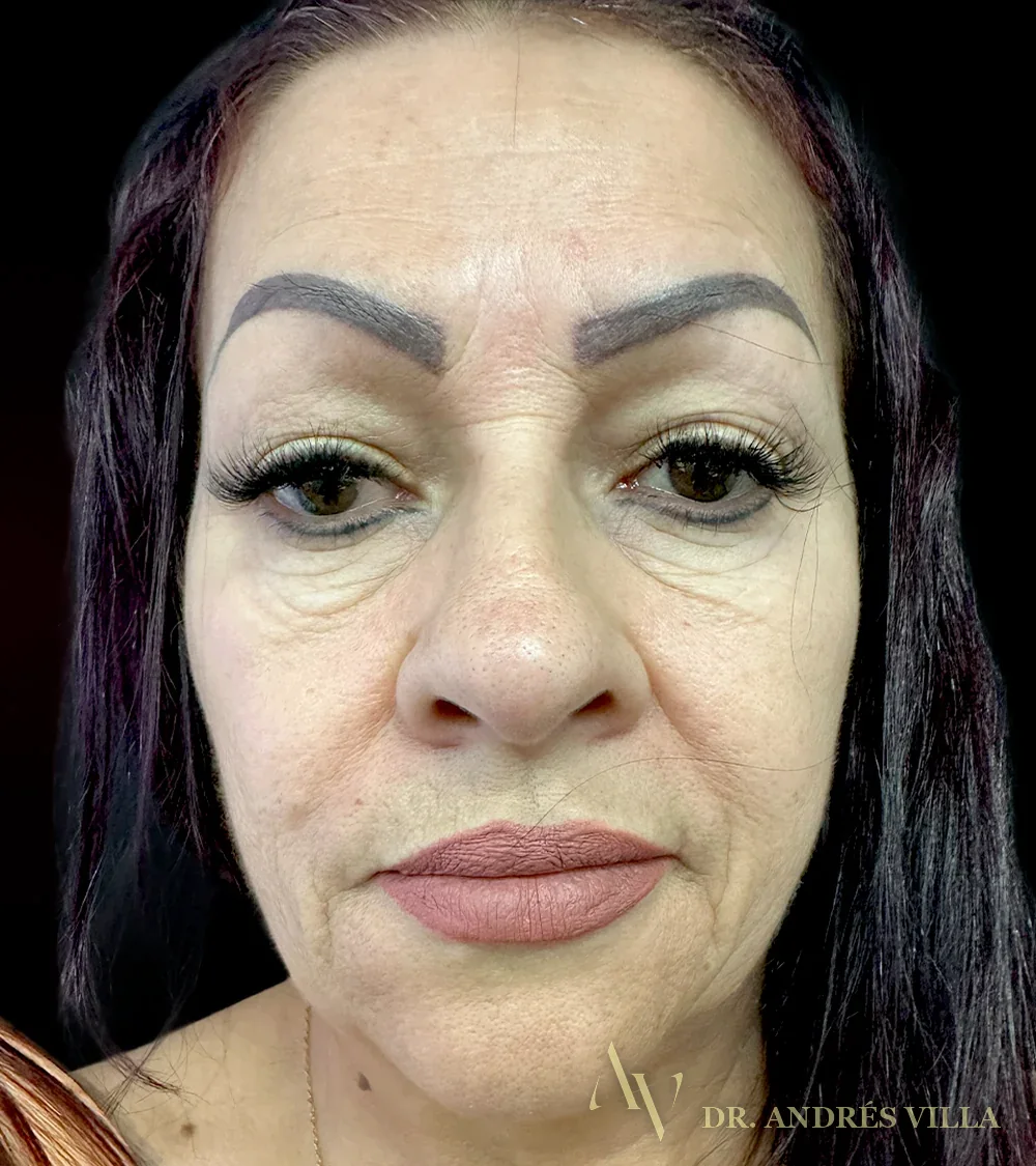 Blefaroplastia. Antes y después, de frente: deslice para comparar.