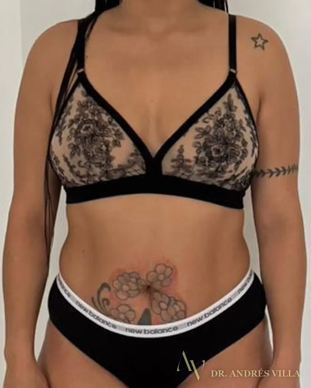 Lipoabdominoplastia circunferencial. Vista frontal, de pie · antes y después.