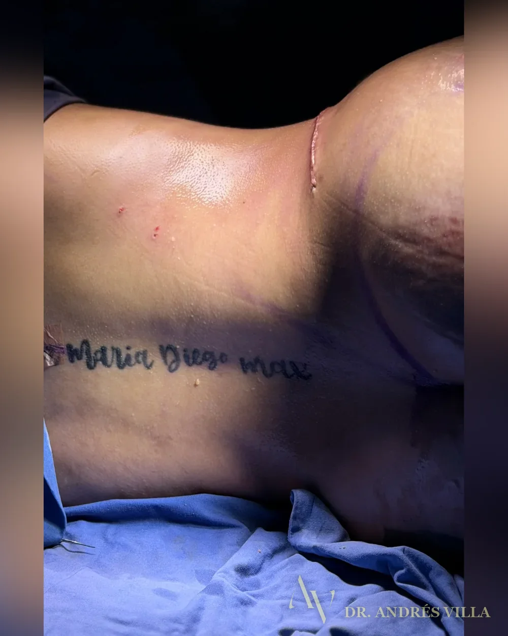 Lipoabdominoplastia circunferencial. Registro en quirófano.