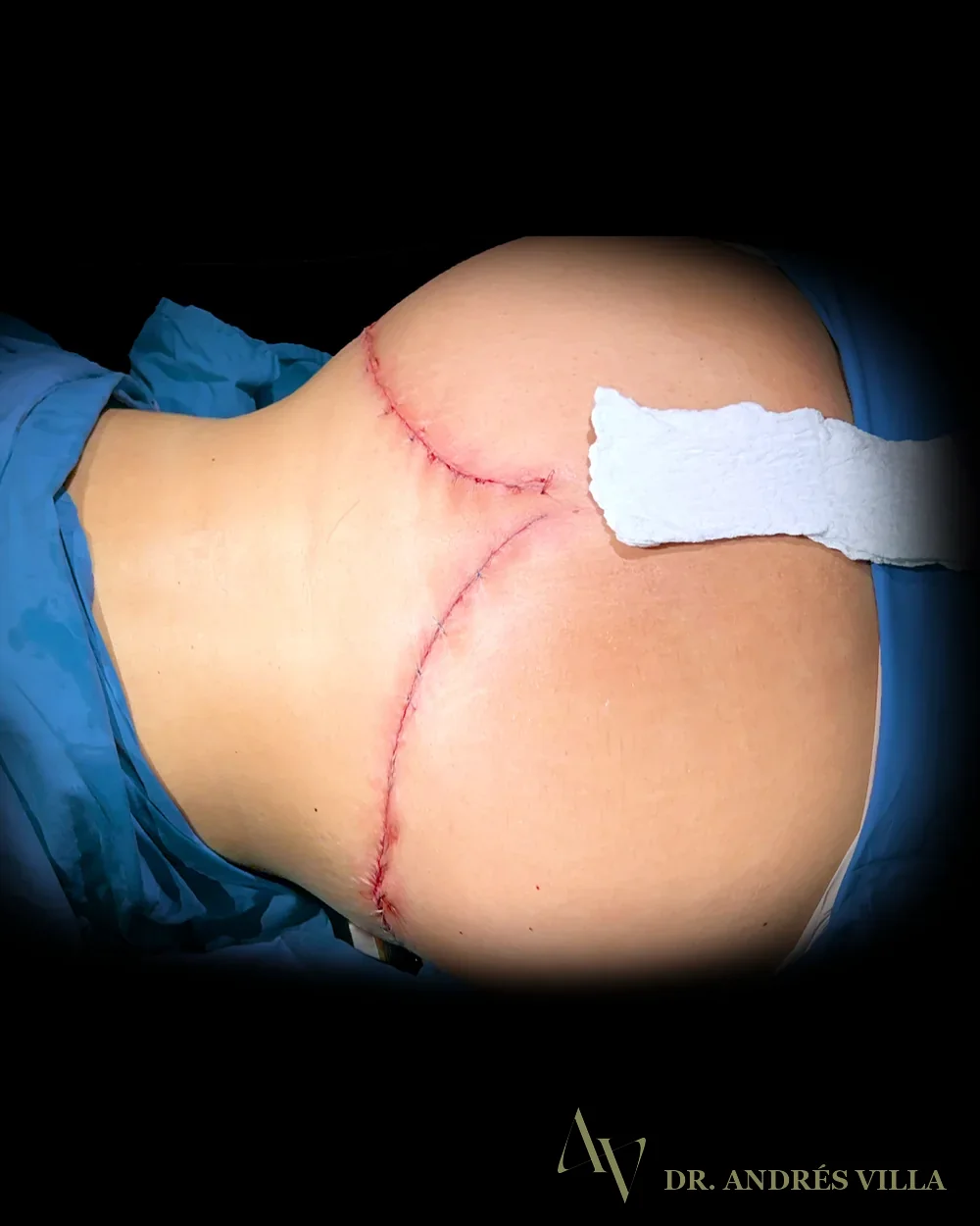 Lipoabdominoplastia extendida. Después · contorno posterior.