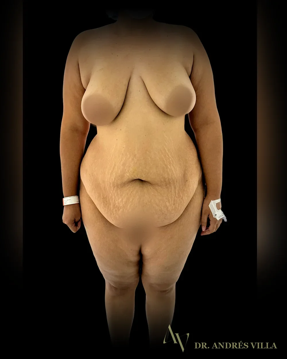 Lipoabdominoplastia extendida. Antes, de pie.