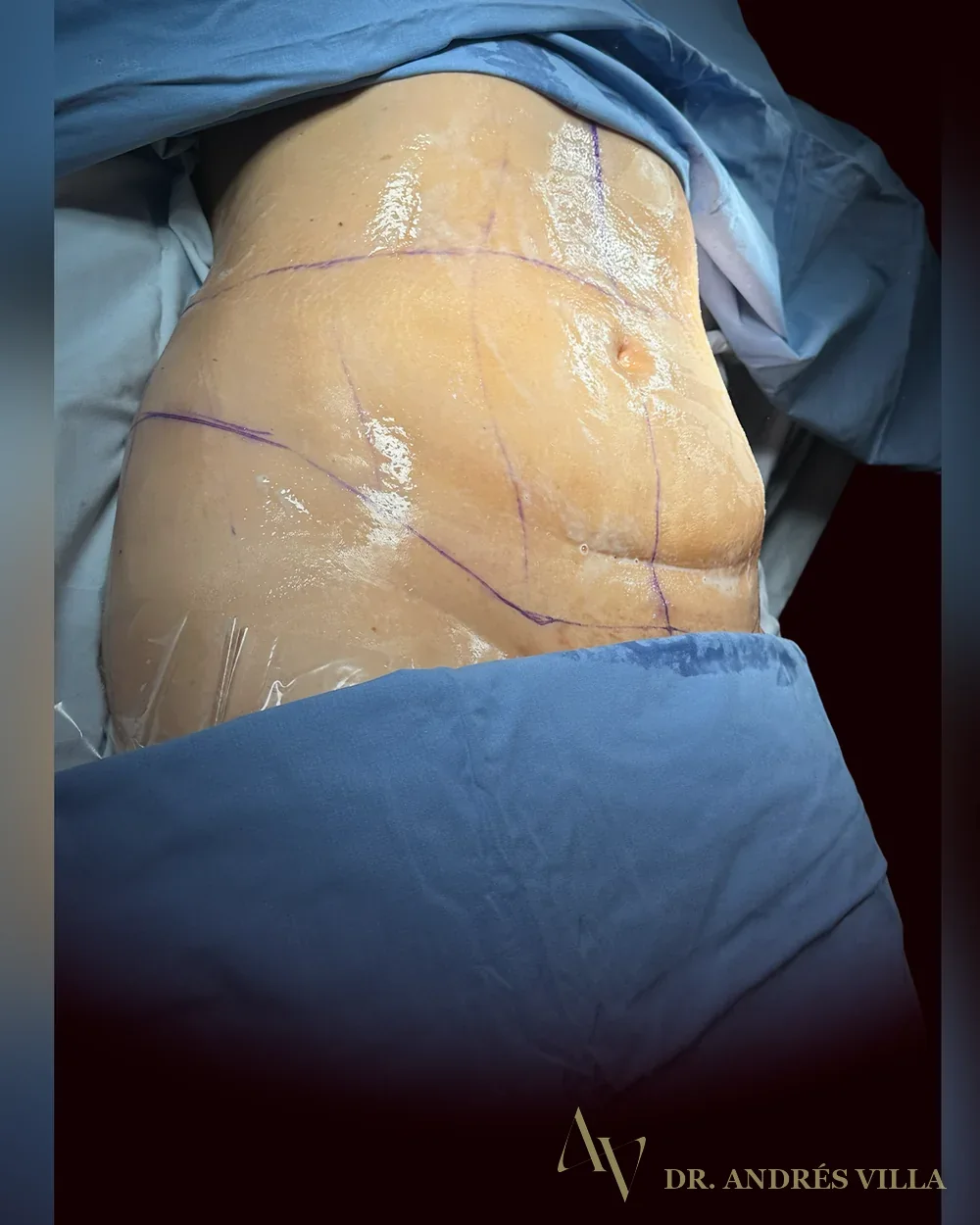 Abdominoplastia. Registro en quirófano.