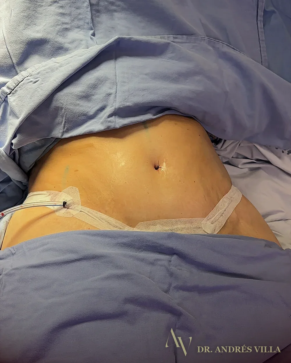 Abdominoplastia. Contorno abdominal.
