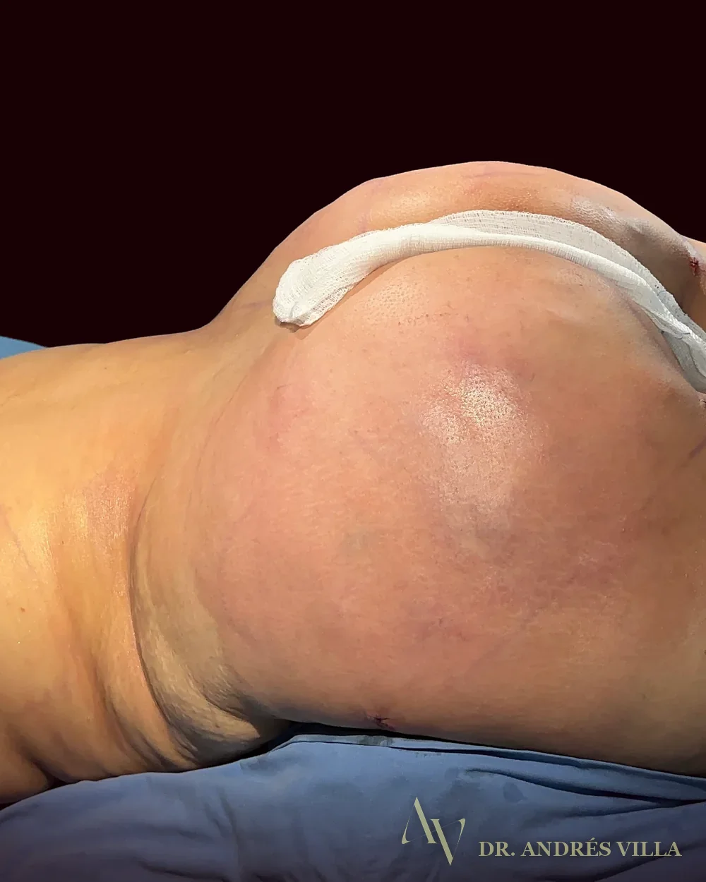 Abdominoplastia con lipotransferencia glútea. Después · proyección glútea.