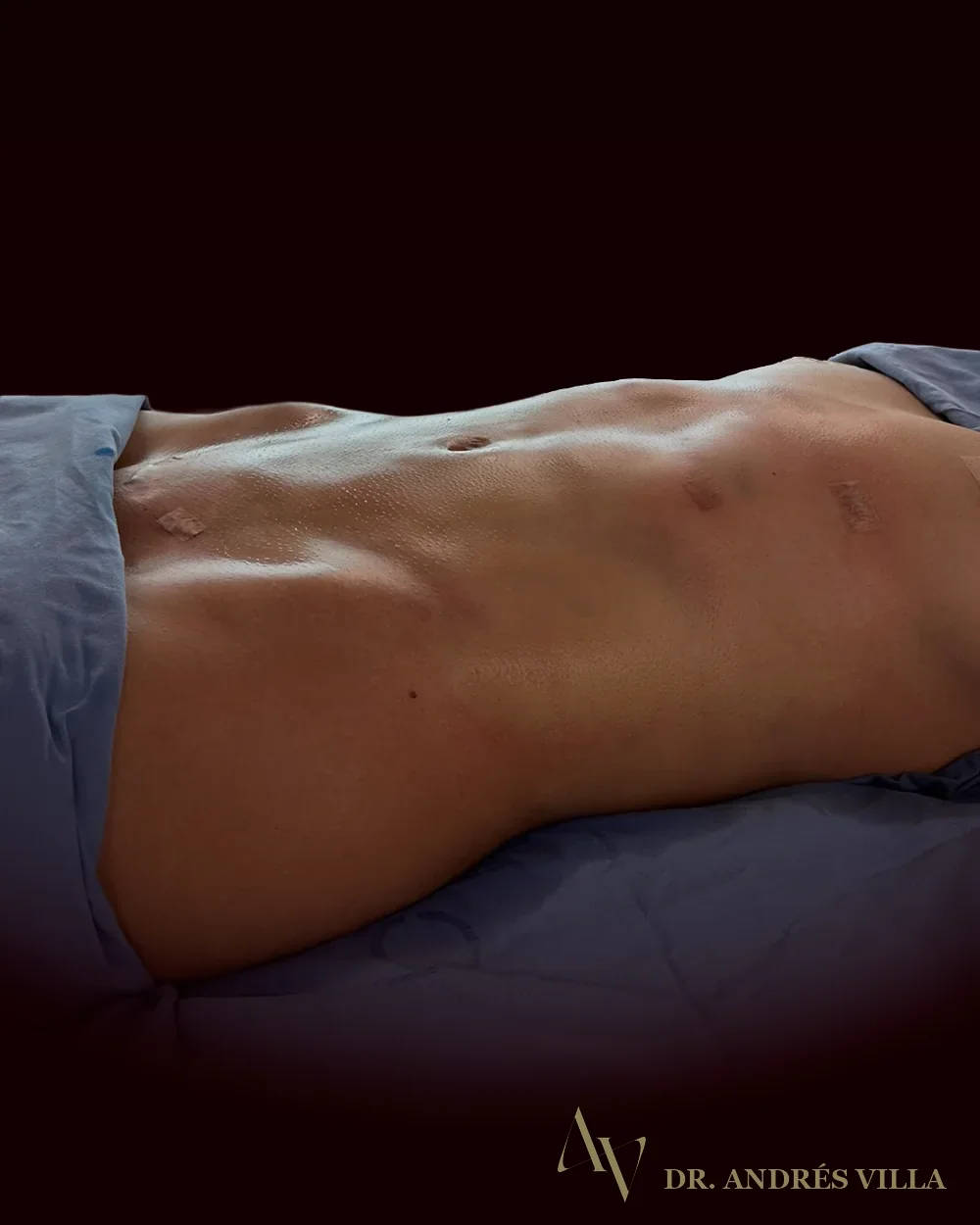 Liposucción con lipotransferencia glútea. Registro en quirófano.