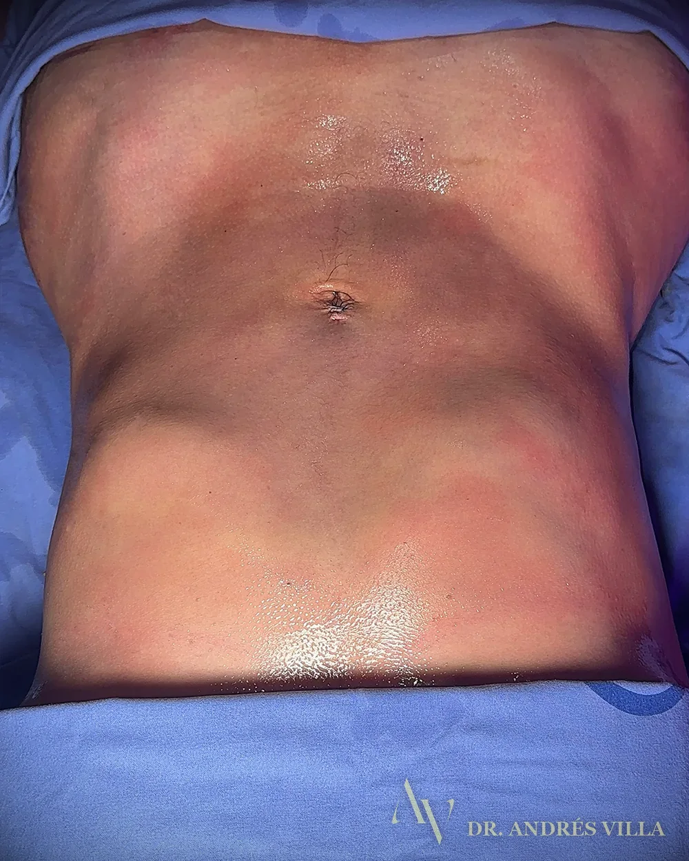 Lipomarcación abdominal. Registro en quirófano.