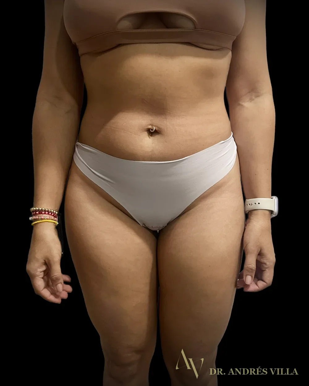 Lipomarcación abdominal. Antes, de pie.