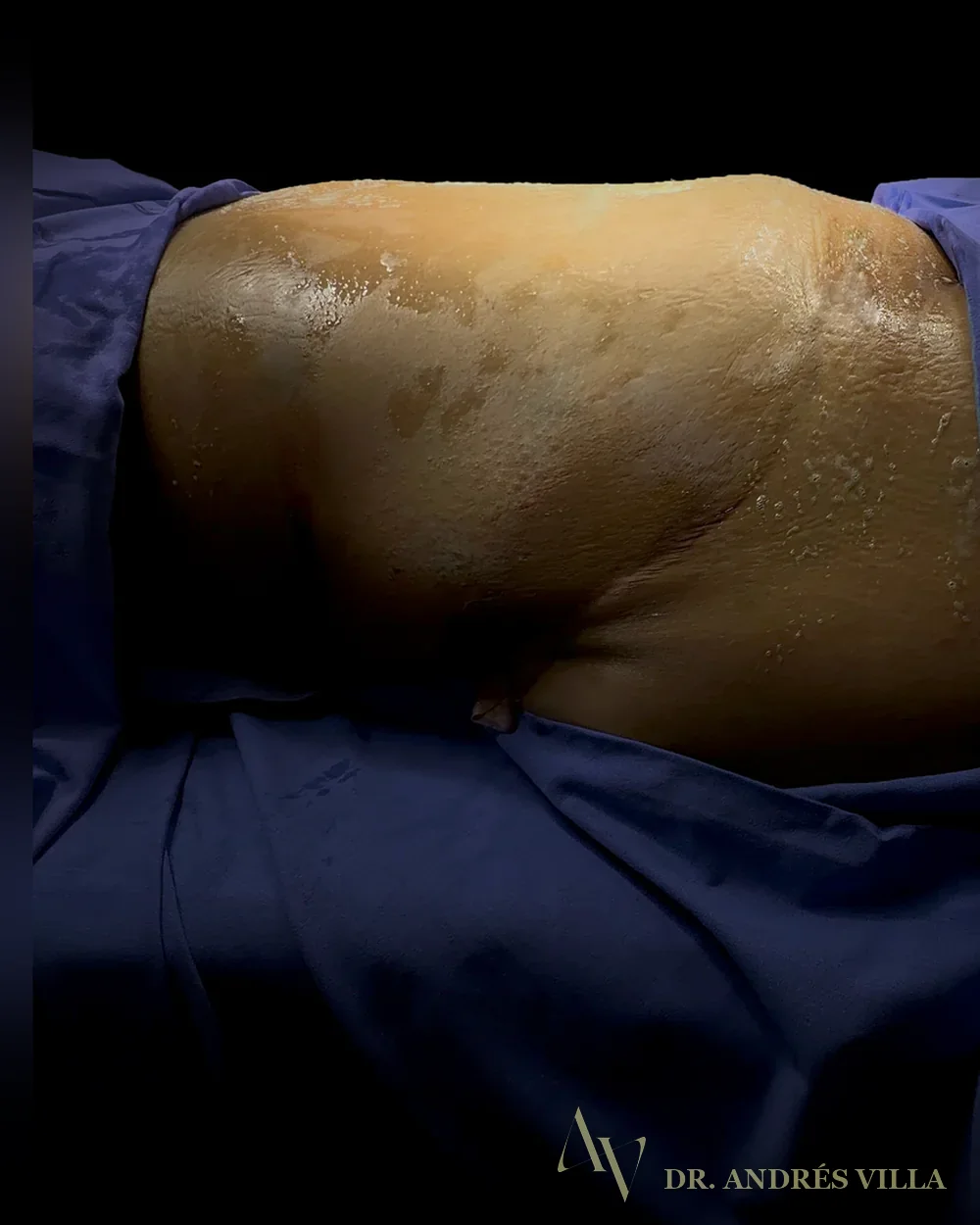 Lipoabdominoplastia extendida. Contorno abdominal · antes y después.