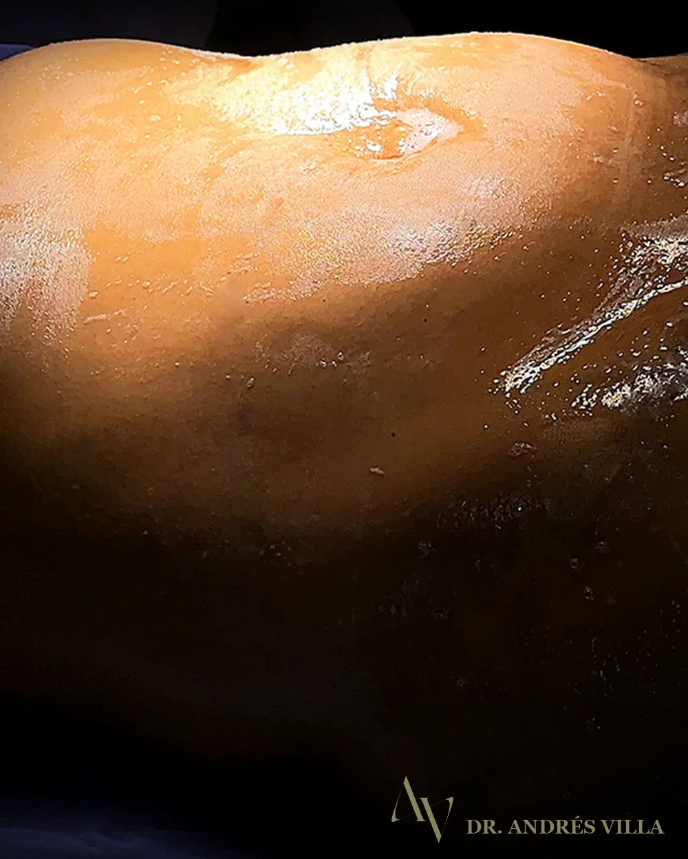 Lipoabdominoplastia. Contorno abdominal · antes y después.